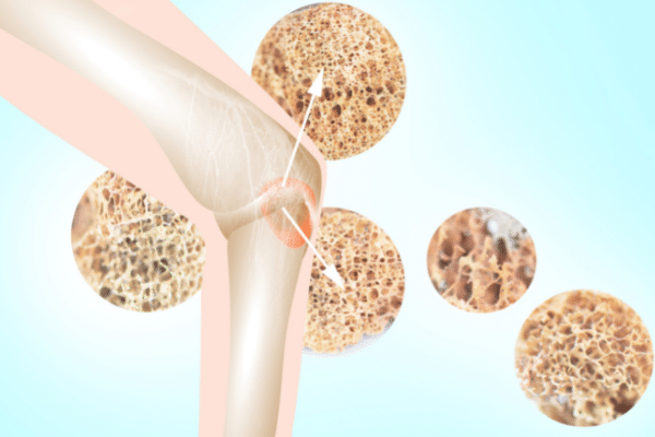 Hoe kan ik mijn botten versterken?